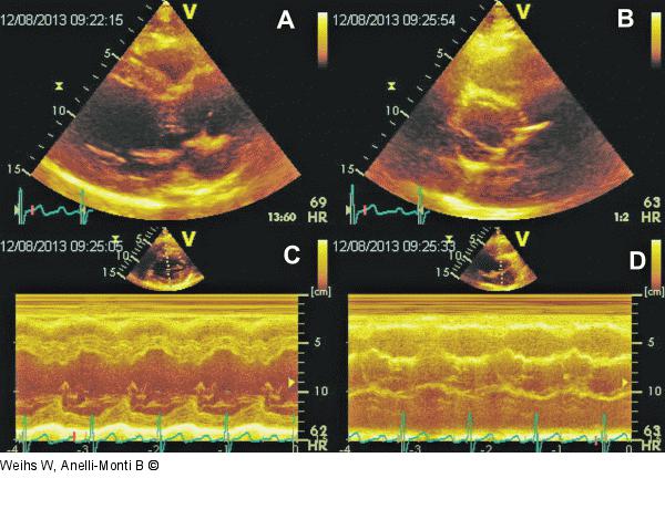 Bikuspide Aortenklappe