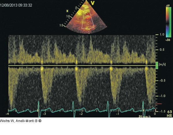 Holodiastolischer Rückfluss