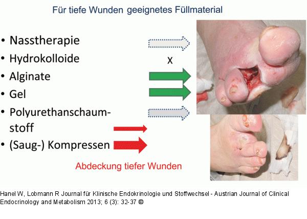 Diabetisches Fußsyndrom