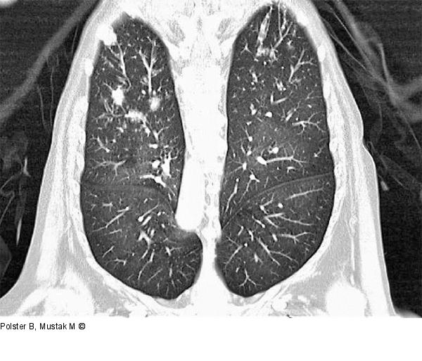 Rheumapatienten im OP
