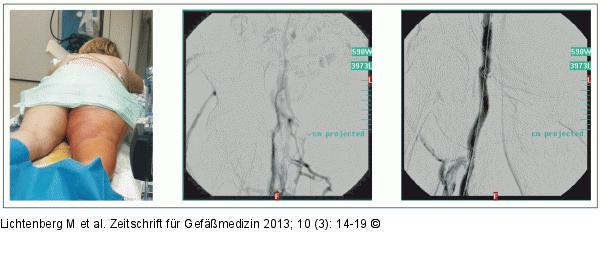 Rotationsthrombektomie