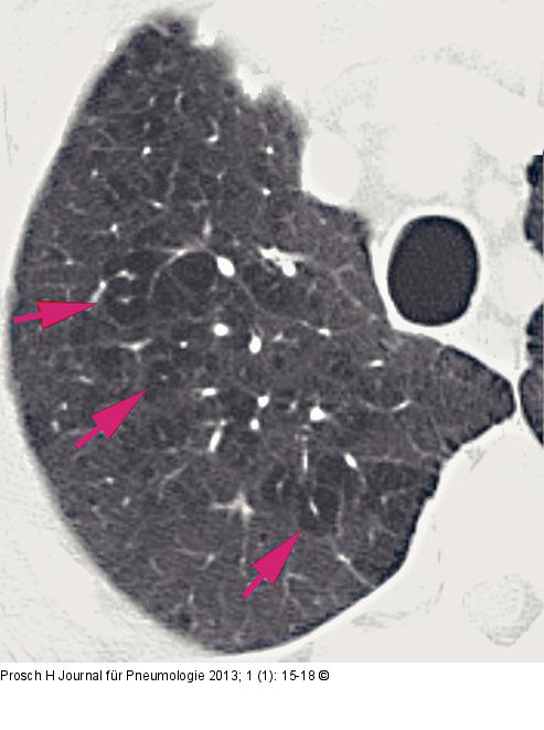 Computertomographie-COPD