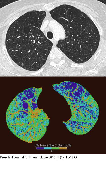 Computertomographie-COPD