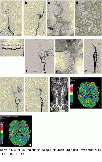 Schlaganfall-Management