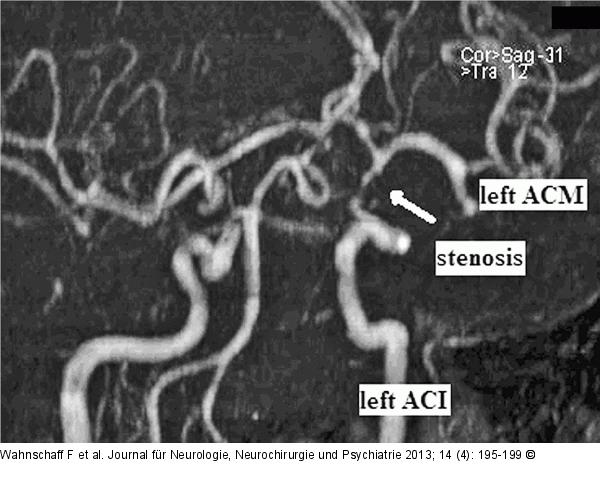 Hypophysenadenom