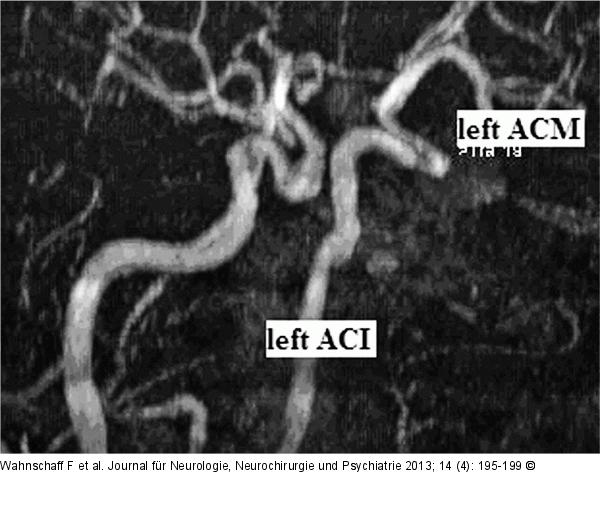 Hypophysenadenom