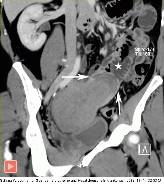 MDCT - 3D-Rekonstruktion