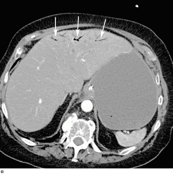 Intrahepatische Pfortaderäste