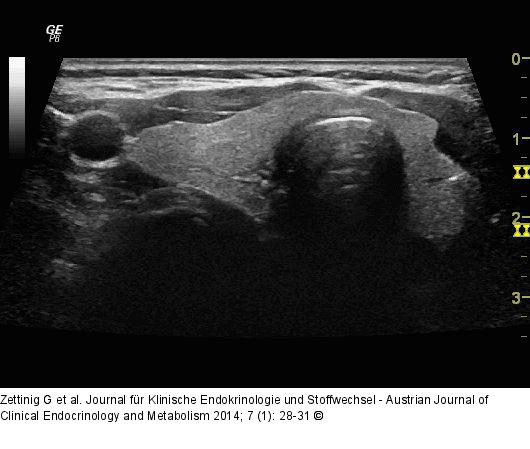 Video 1 - Rechter Lappen