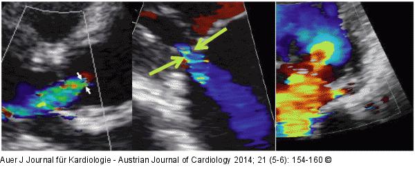 Herzklappeninsuffizienz