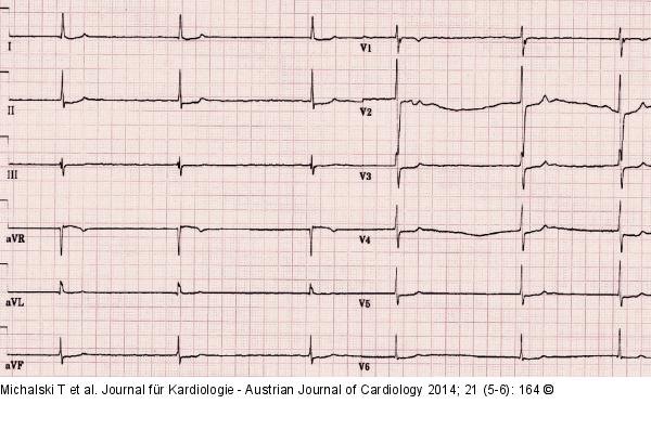 Bradyarrhythmia absoluta