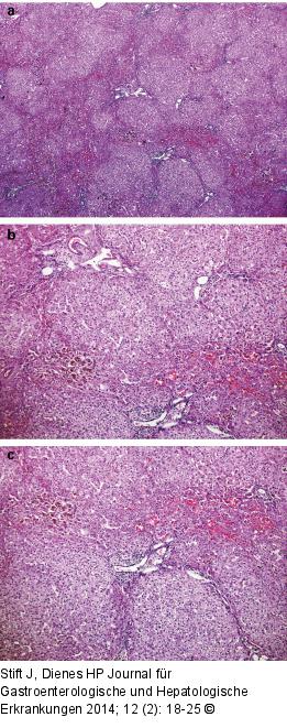Transplantatabstoßung