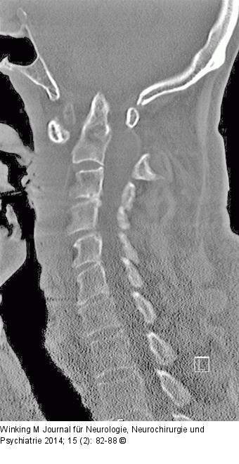 Rheumatische Wirbelsäule