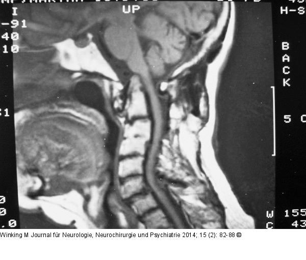 Rheumatische Wirbelsäule