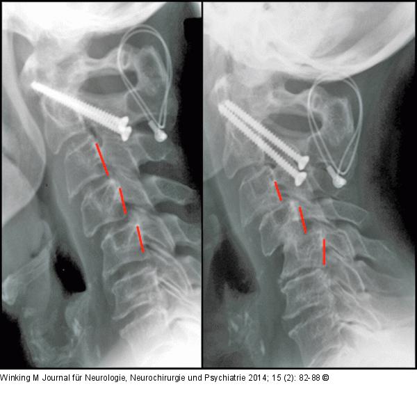 Rheumatische Wirbelsäule