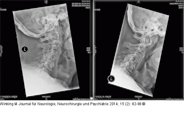 Rheumatische Wirbelsäule