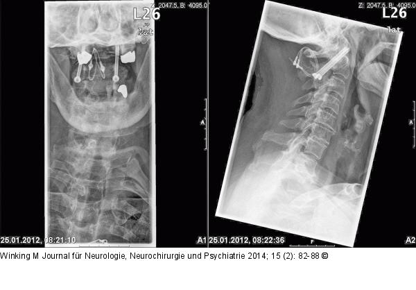Rheumatische Wirbelsäule