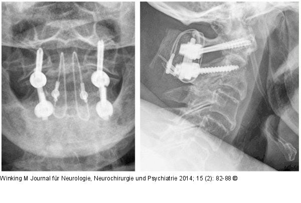 Rheumatische Wirbelsäule