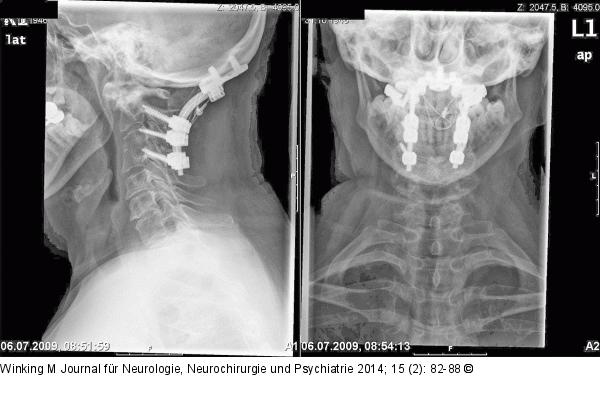 Rheumatische Wirbelsäule