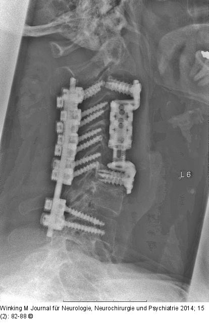 Rheumatische Wirbelsäule