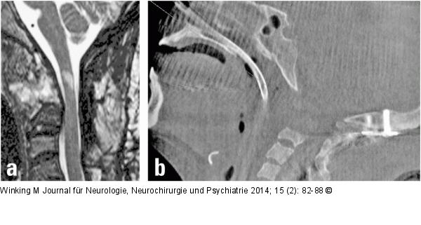 Rheumatische Wirbelsäule