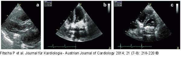 Hyperdense echogene Struktur