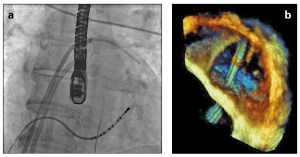 Produkt: EchoNavigator<br>Vertrieb: Philips 