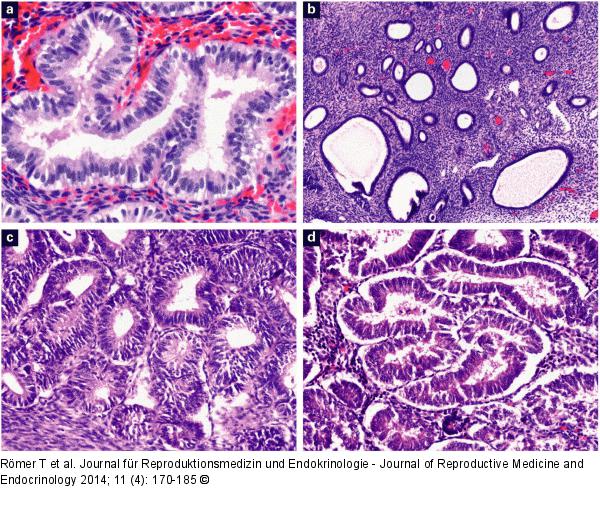 Endometriumveränderungen