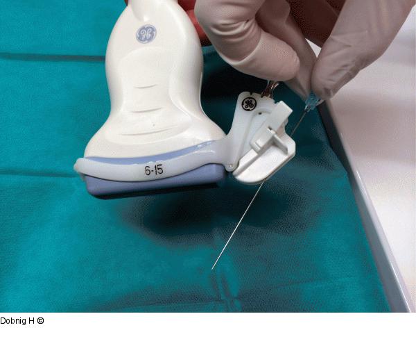 Alkoholablation - Schilddrüse