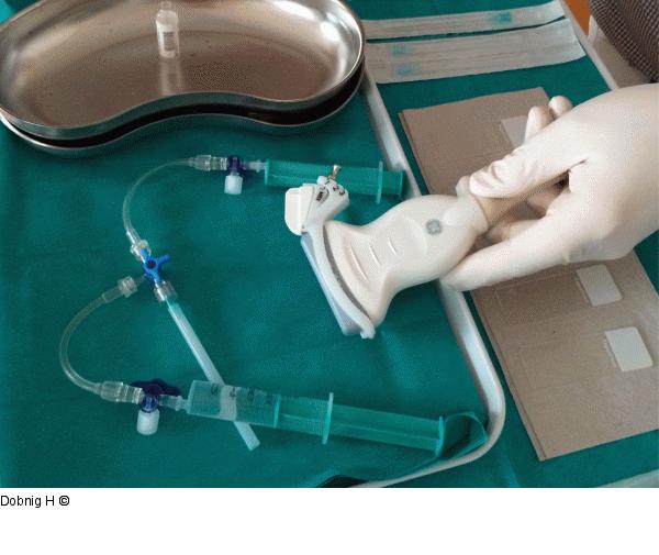 Alkoholablation - Schilddrüse