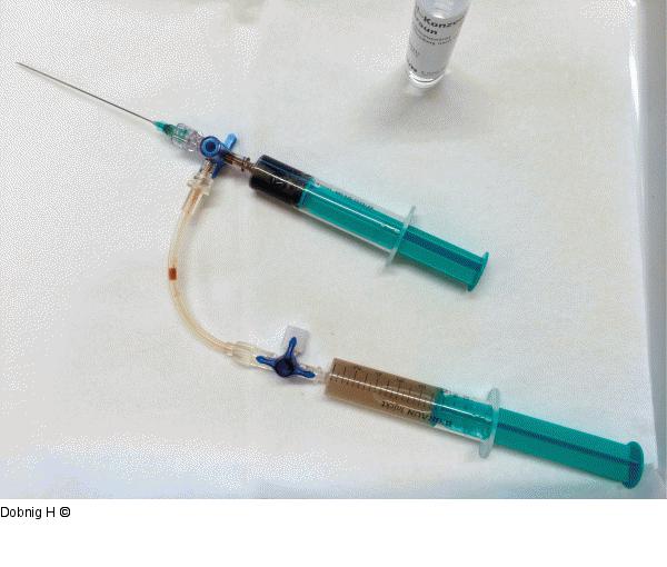 Alkoholablation - Schilddrüse