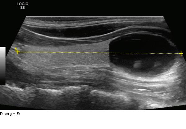 Alkoholablation - Schilddrüse
