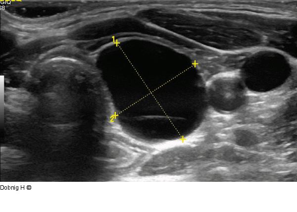 Alkoholablation - Schilddrüse