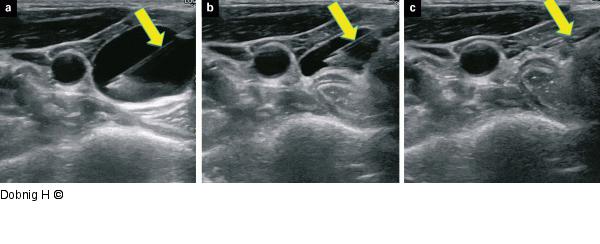 Alkoholablation - Schilddrüse