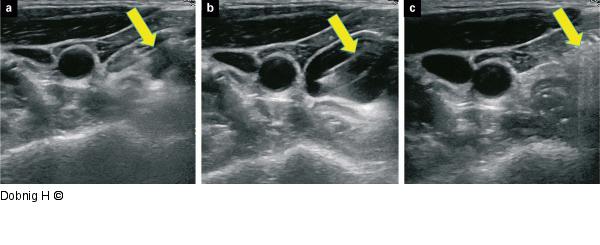 Alkoholablation - Schilddrüse