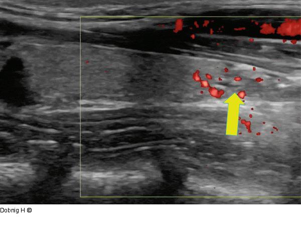 Alkoholablation - Schilddrüse