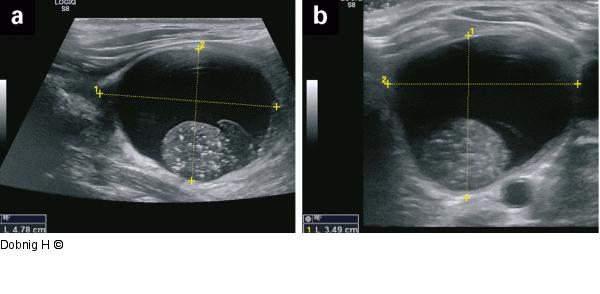 Alkoholablation - Schilddrüse