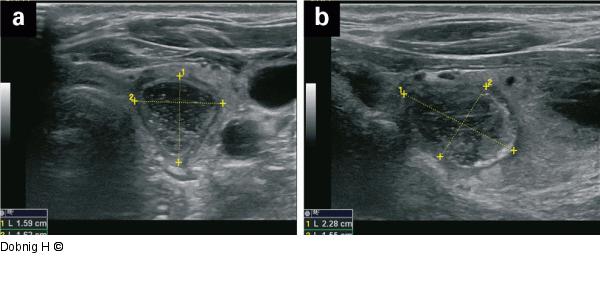Alkoholablation - Schilddrüse