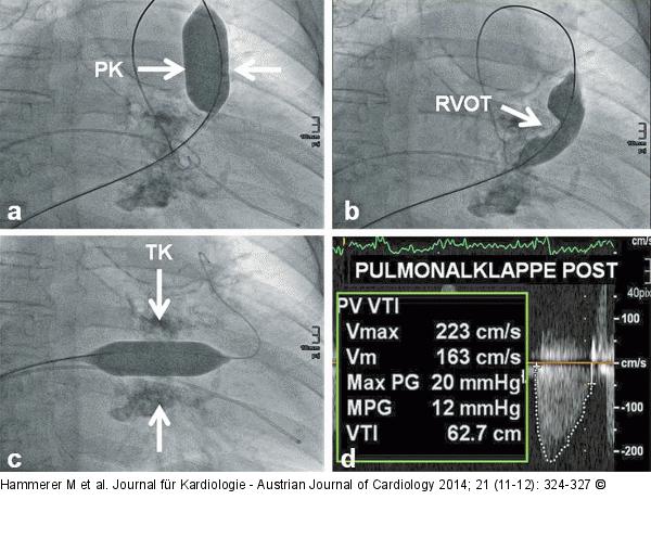 Ballonvalvuloplastie