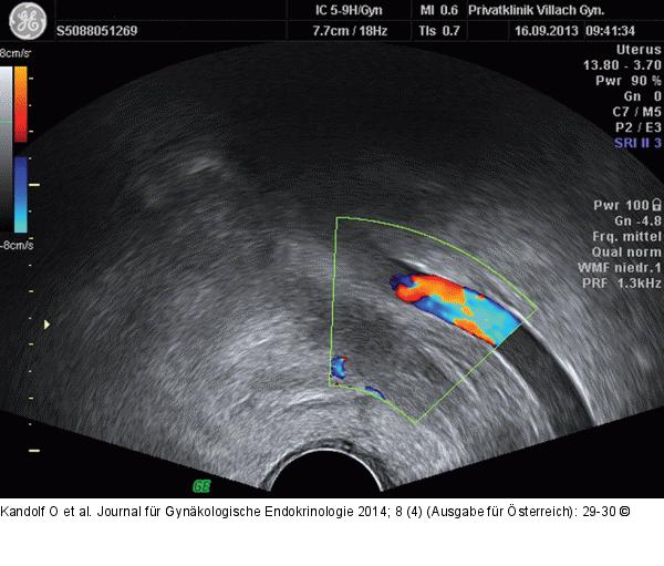 Venöse Thromboembolie