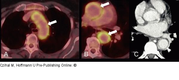 Riesenzellarteriitis