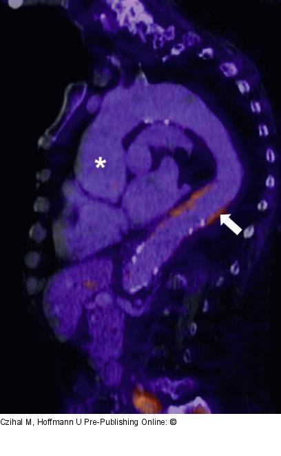 Riesenzellarteriitis