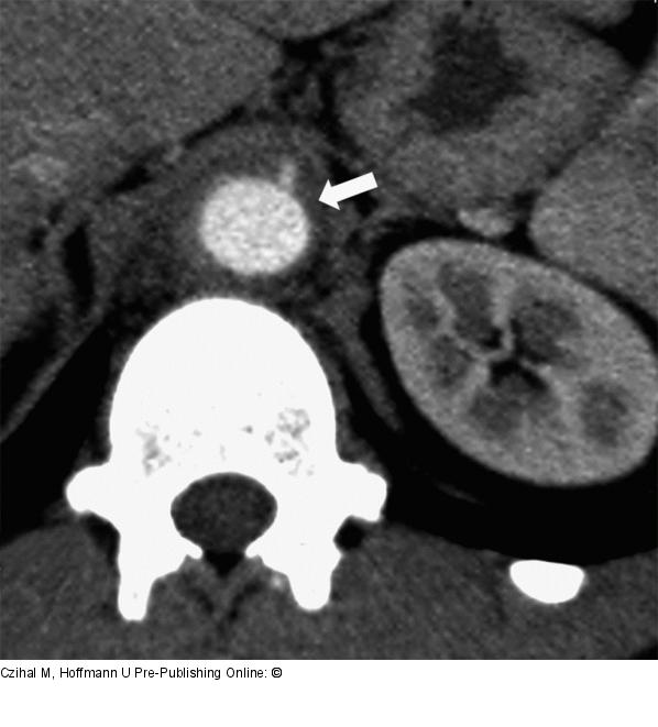 Aorta abdominalis - Pannus