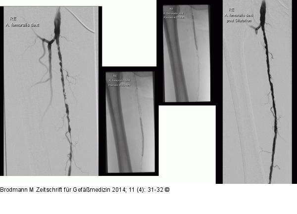 CTO-Revaskularisation