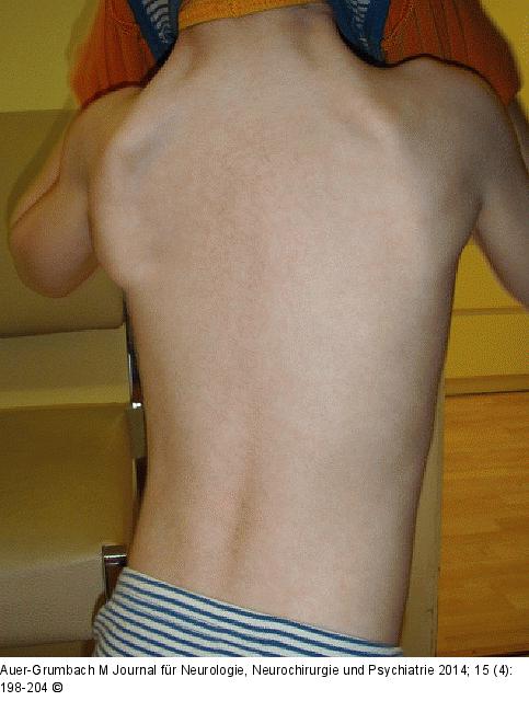 Hereditäre Neuropathie