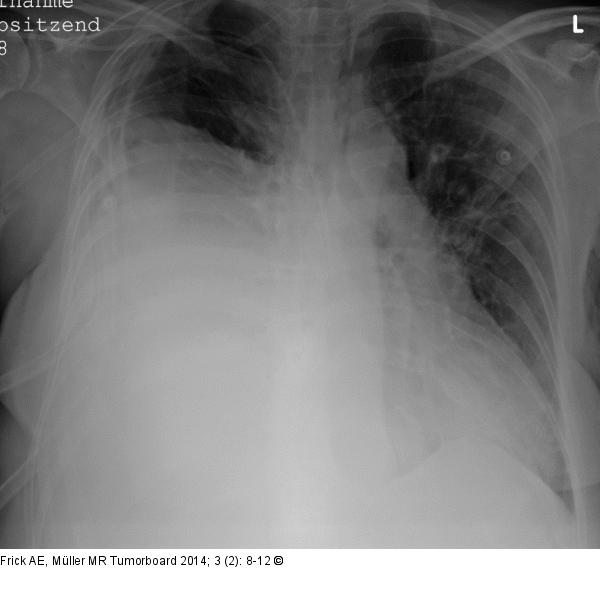 Biphasisches Synovialsarkom