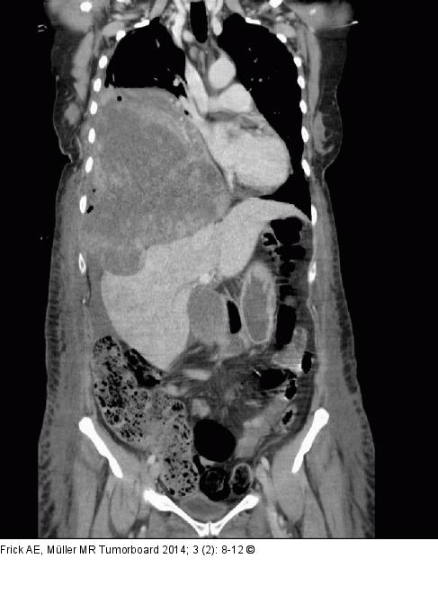 Biphasisches Synovialsarkom