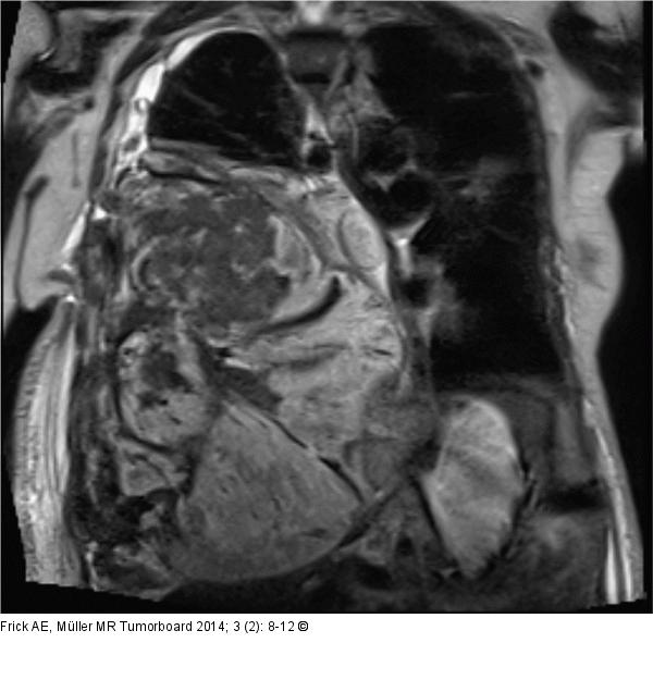 Biphasisches Synovialsarkom