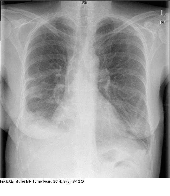 Biphasisches Synovialsarkom