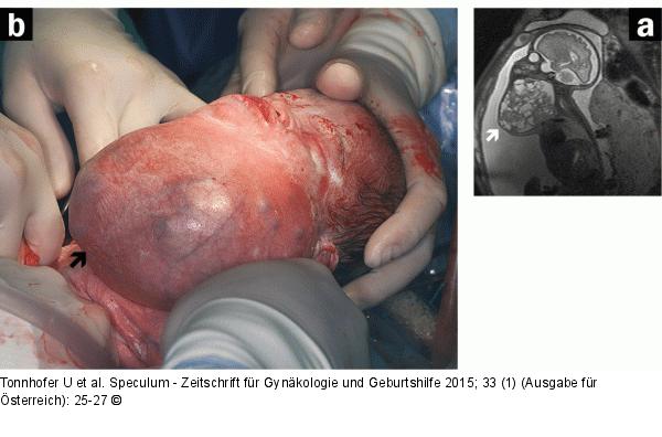 Pränataldiagnostik-Therapie